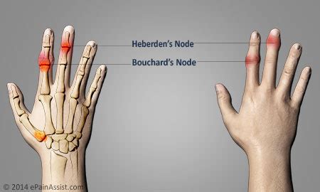 Osteoarthritis Of Hands|Risk Factors|Symptoms|Signs|Treatment-Medications, Surgery