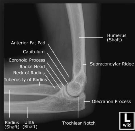 Elbow Dislocation – Core EM