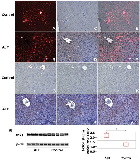 Immunohistochemical detection of pimonidazole, hypoxia inducible factor ...