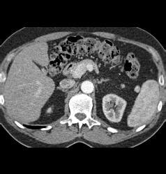 Splenule Near the Splenic Hilum - Spleen Case Studies - CTisus CT Scanning