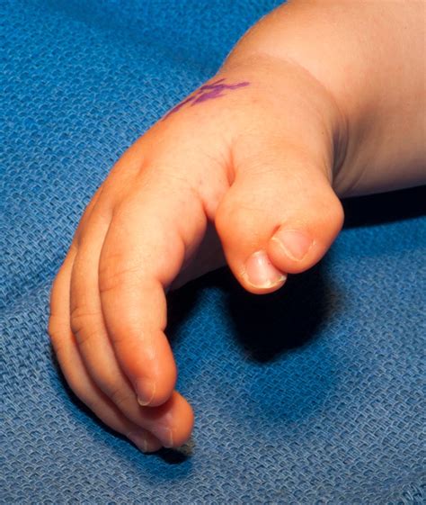 The Extra Thumb | Congenital Hand and Arm Differences | Washington ...