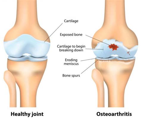 Best Stem Cell Treatment for Osteoarthritis of Knee, Ankle, Hip ...