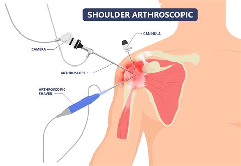 Shoulder Arthroscopy Chillicothe, OH - Shoulder Pain Surgery | Dr. Cohen