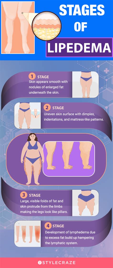 6 Health Benefits Of Lipedema Diet, Exercise, & What To Eat