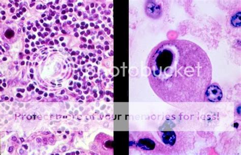 Owl\'s Eye= CMV \"Sightomegalovirus\" Basophilic Intranuclear Inclision. Photo by usmle ...