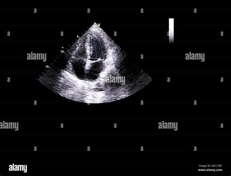 Screen of an ultrasound machine with a heart image Stock Photo - Alamy