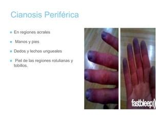 Semiología de la Cianosis. | PPT