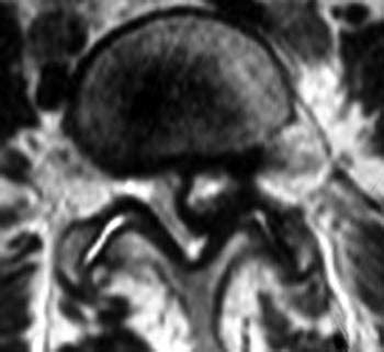 Lumbar Synovial Cyst | Radsource