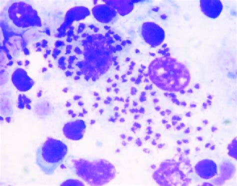 Bone marrow section showing hypocellular marrow with diminished.... | Download Scientific Diagram