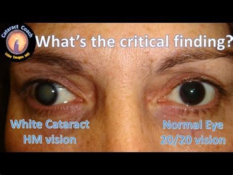 Dense White Cataract Surgery with Phaco Chop Technique - YouTube