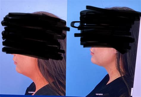 3 month recovery: chin lipo + thermitight : r/PlasticSurgery