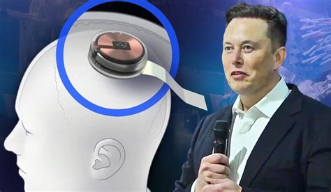 Musk Says, Neuralink’s First-in-Human Clinical Trial is Open for ...