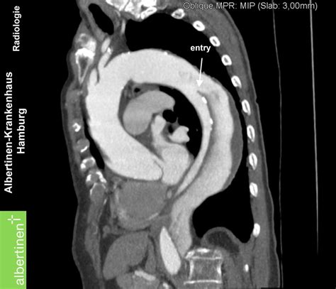 CT: Aortendissektion längs Thorax - DocCheck