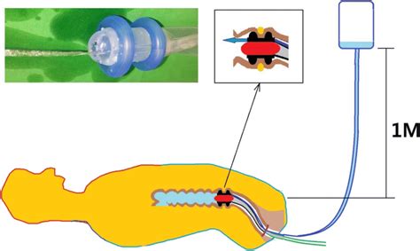 Irrigation of fecal diversion device after primary surgery | Download Scientific Diagram