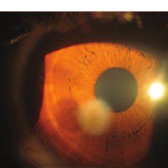 Examples of slit lamp images. (a) Active corneal ulcer - infectious or... | Download Scientific ...