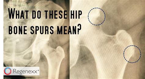 Bone Spur Pain - Why Relief May Be Simpler Than You Think