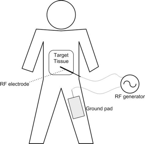 Overview of an RF ablation procedure. A RF electrode is inserted into... | Download Scientific ...