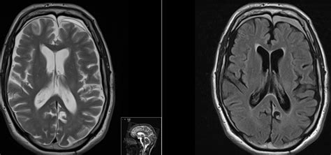 Chronic Subdural Hematomas - MRI