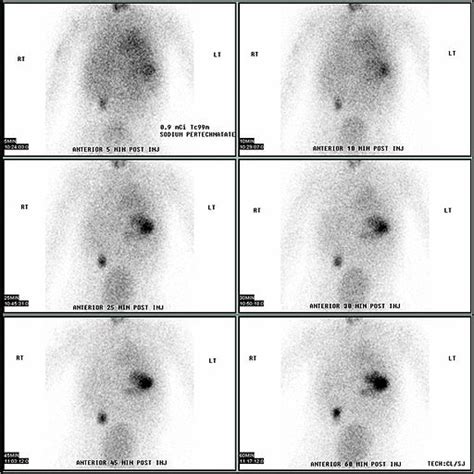 Meckel's diverticulum other imaging findings - wikidoc