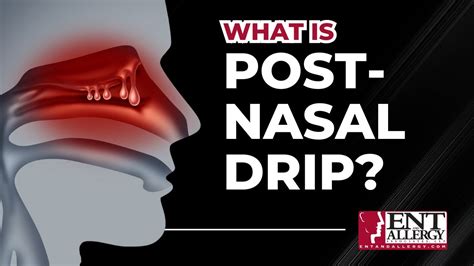 What is Post-nasal Drip Syndrome? - YouTube