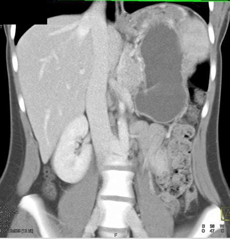 Pseudocyst in Lesser Sac - Stomach Case Studies - CTisus CT Scanning