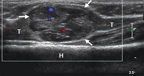 Low-Flow Vascular Malformation Pitfalls: From Clinical Examination to Practical Imaging ...