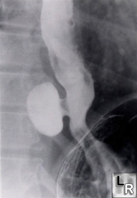 RADIOLOGY, PREGNANCY, INFECTION AND TREATMENT: CHEST RADIOLOGY (1-50 SAMPLES)