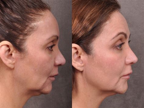 Laser Facelift / Profound MicroLift – Before & Afters - Beverly Hills ...