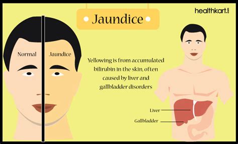 How to deal with Jaundice symptoms? - HealthKart