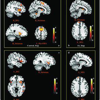 | Brain activation during response inhibition in the controls and the... | Download Scientific ...