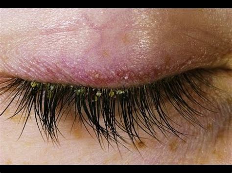 How to Get Rid of Lash Mites Eyelash Extensions – Best Idol Eyelash