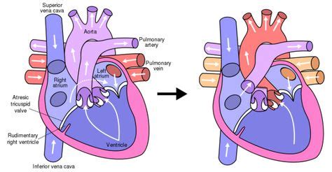 Here is a better picture of the Fontan procedure. (With images ...