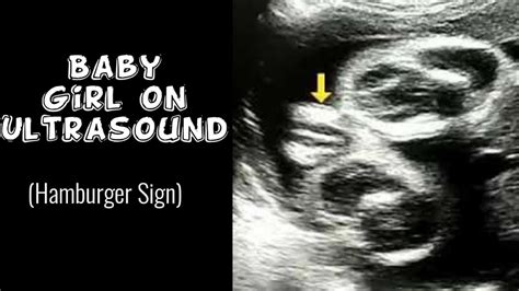 Baby Girl on Ultrasound | Female Baby | Hamburger Sign | Gender Identification - YouTube