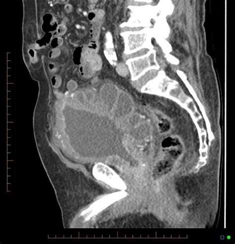 Bladder Outlet Obstruction - Causes, Symptoms, Diagnosis...