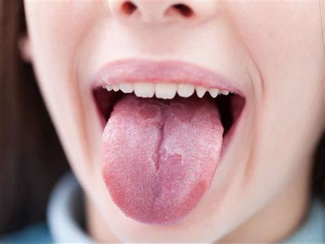 Tongue Swelling Causes, Symptoms, Treatment, Piercing, under & One Side ...