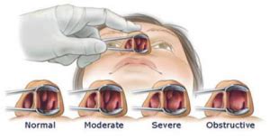 Allergy Doctors Philadelphia | Allergic Rhinitis