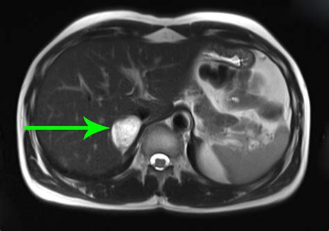 Cureus | Pheochromocytoma Secreting Large Quantities of Both ...