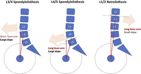 Prevalence and Risk Factors of Degenerative Spondylolisthesis and Retrolisthesis in the ...