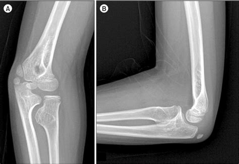 Figure 6 from Osteochondroma of the Radial Tuberosity in Child ...