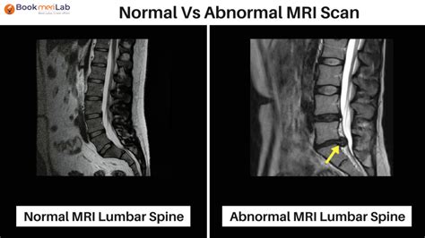 MRI LS Spine: Price, Purpose, Risks & Results [2024]