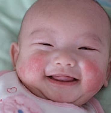 Baby Acne Cure and Treatment: Baby Eczema Pictures : What Looks Like Baby Eczema?