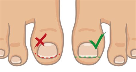 Preventing Ingrown Toenails - How to prevent ingrown toenails