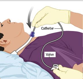 Tracheostomy Tube Suctioning