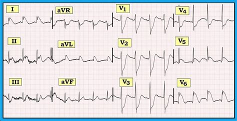 ECG Interpretation: ECG Blog #131 (Acute STEMI – Acute Occlusion of LAD – LCx – RCA)