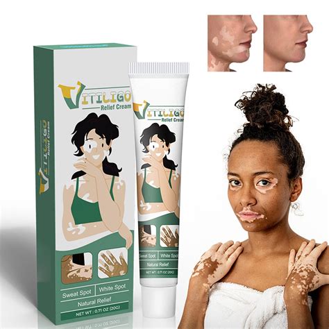Buy Shinyme Vitiligo Skin Repair Cream, Vitiligo Cream, Vitiligo Care Cream for Skin Vitiligo ...