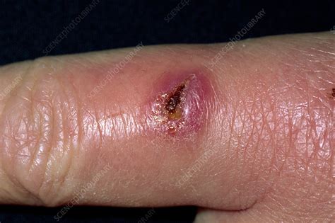 Infected cut - Stock Image - M330/1008 - Science Photo Library