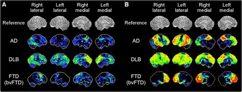 Pet Scan Brain Dementia