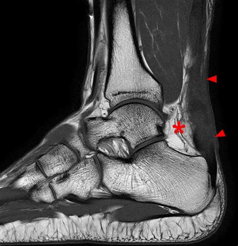 Achilles Tendon Pathology | Radsource