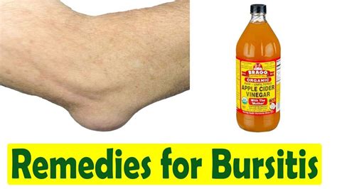 Knee Bursitis Treatment Home Remedies