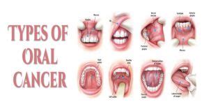 Different Types of Oral / Mouth Cancers